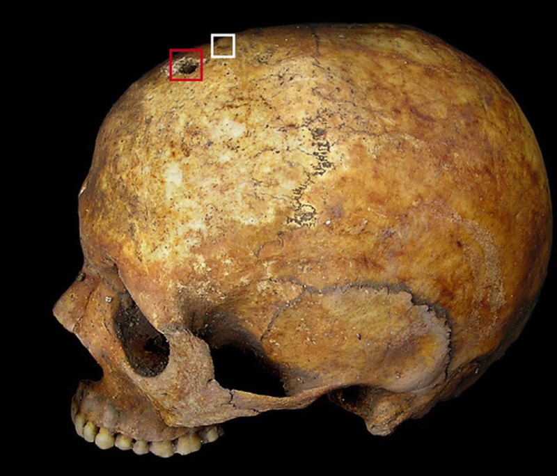 The evidence of trepanation.